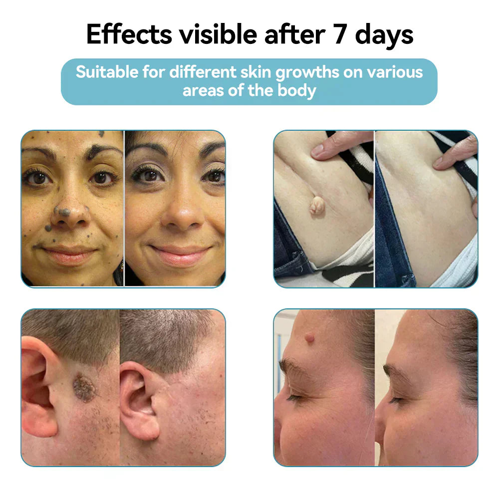 ✨QIAWI™ All-in-One CO₂ Laser Eraser Pen | Removes Moles, Warts, Skin Flaws & Pigmentation