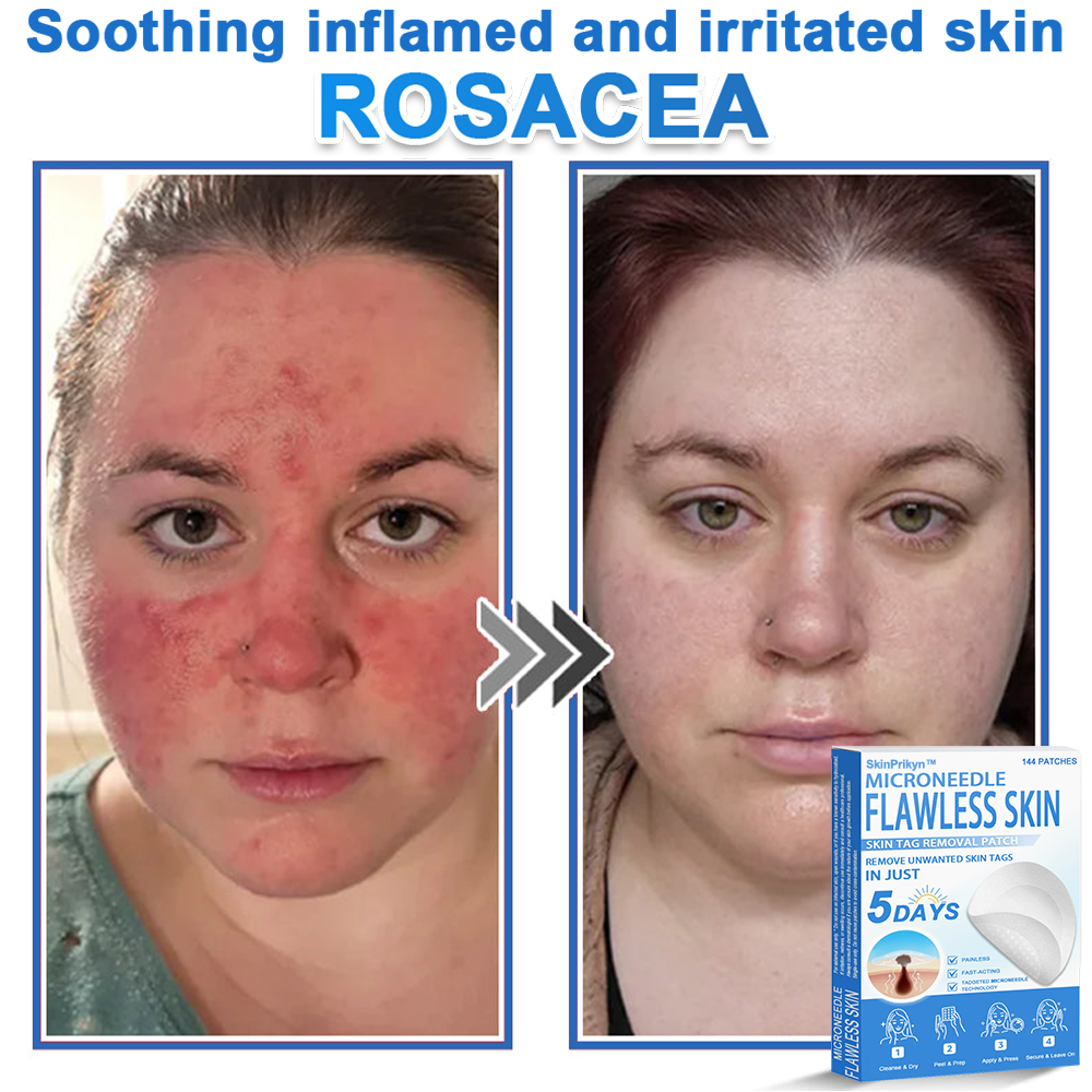 🎁 SkinPrikyn™ 2-in-1 Microneedle & Hydrocolloid Patch