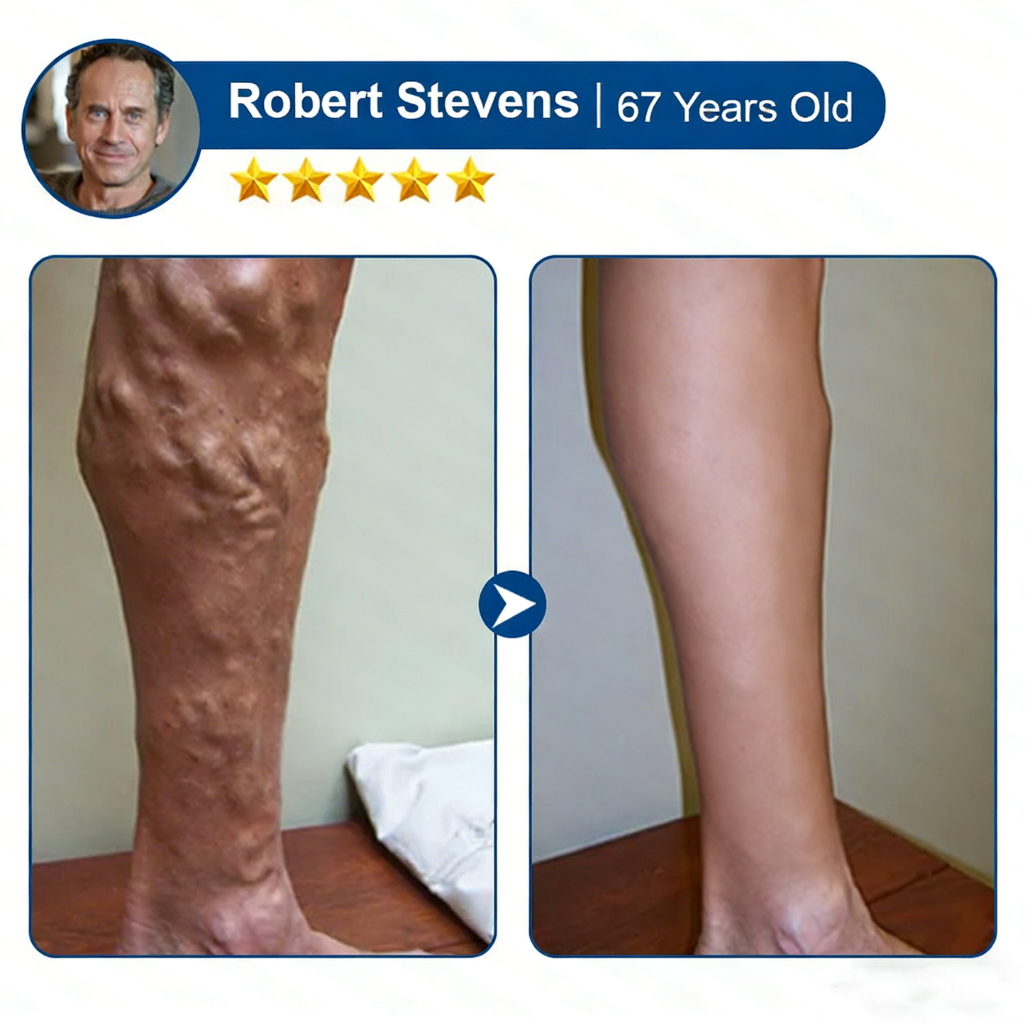 Alisanda® 𝑽𝗲𝗶𝙣 𝘾𝐨𝐧𝘁𝗼𝙪𝙧 𝙈𝙞𝐜𝐫𝒐𝒏𝒆𝗲𝗱𝗹𝙚 𝙋𝙖𝐭𝐜𝒉 𝒘𝒊𝘁𝗵 𝗔𝙙𝙫𝙖𝙣𝙘𝐞𝐝 𝐃𝒊𝒐𝒔𝗺𝙞𝐧 & 𝑯𝒆𝘀𝗽𝗲𝙧𝙞𝙙𝙞𝐧 𝐃𝒆𝒍𝒊𝒗𝗲𝗿𝙮🌿𝟕-𝐃𝐚𝐲 𝐕𝐢𝐬𝐢𝐛𝐥𝐞 𝐑𝐞𝐬𝐮𝐥𝐭𝐬 𝐟𝐨𝐫 𝐕𝐚𝐫𝐢𝐜𝐨𝐬𝐞 𝐕𝐞𝐢𝐧𝐬